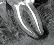 Endo Resolution X-Ray scan